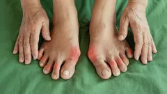 Heb je last van pijn in je teennaden? Experts leggen uit hoe je hier voorgoed vanaf kunt komen